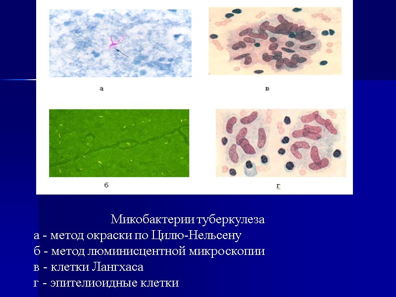 Микобактерии туберкулеза а - метод окраски по Цилю-Нельсену б - метод люминисцентной микроскопии в